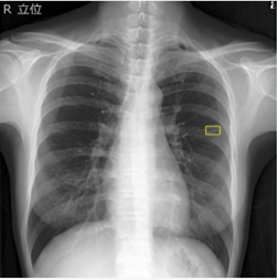 胸部レントゲン画像AI診断支援システム（エルピクセル社EIRL cloud™）